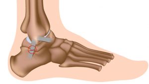 Ankle sprain - Sprained ankle
