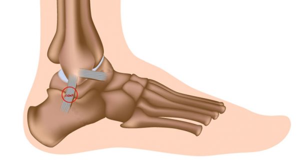 Ankle sprain - Sprained ankle