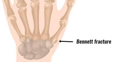 Rolando fracture