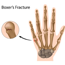 Boxers Fracture - broken hand