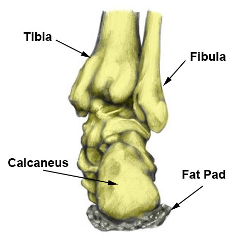 Bruised heel bone