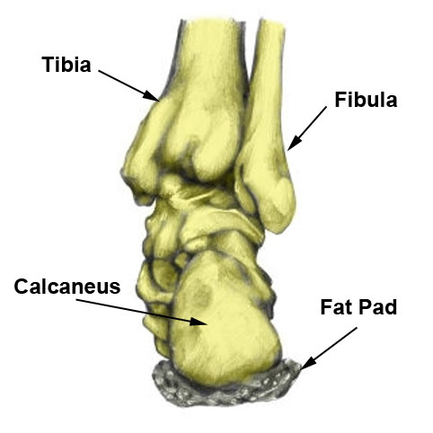 Shattered Calcaneus (heel bone)