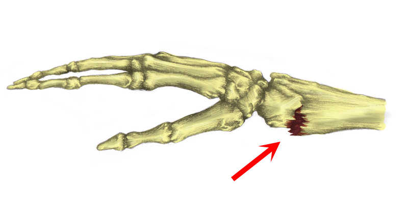 Colles Fracture of the Wrist - Symptoms, Causes, Treatment & Surgery