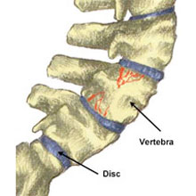 Lower back injuries - spinal compression fracture