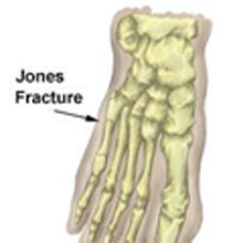 Jones Fracture