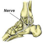 medial calcaneal nerve entrapment