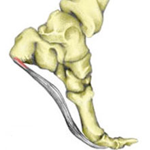 Fascitis plantar - Dolor en el arco del pie