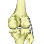 posterolateral corner injury