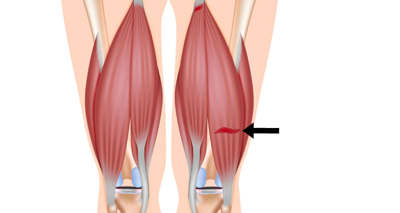 Pulled Hamstring strain