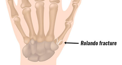 Wrist fracture