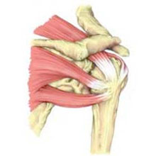 Rotator Cuff Tear