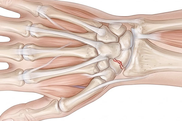 scaphoid wrist fracture
