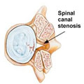 Spinal canal stenosis