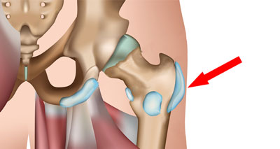 Hip bursitis pain