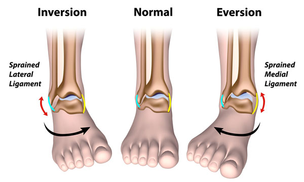 Types of ankle sprain - inversion and eversion