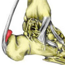 Achilles Bursitis