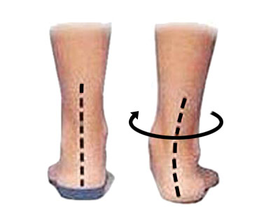 Achilles twisting from overpronation