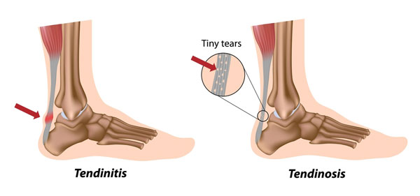 Achilles tendonitis and achilles tendinosis