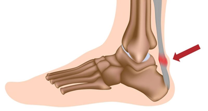 Achilles Tenosynovitis - Symptoms, Causes and Treatment