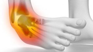 Acute ankle injuries