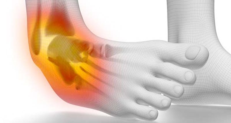 Acute ankle injuries