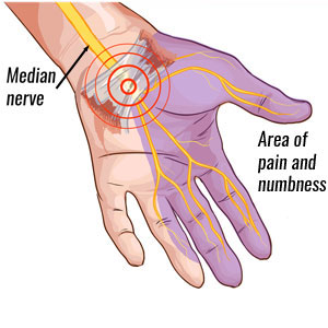 Carpal tunnel syndrome symptoms