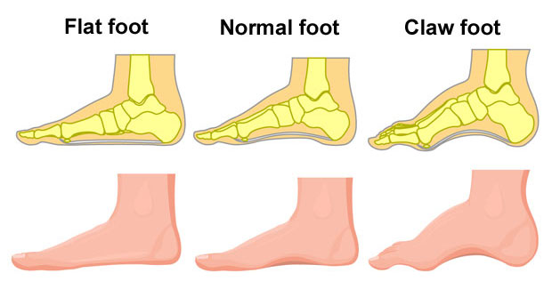 PTTD flat foot