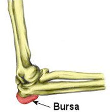 Elbow Bursitis