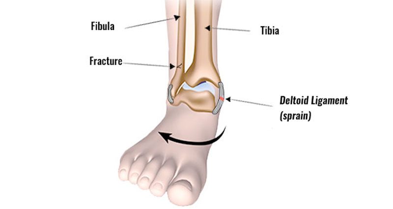 Eversion ankle sprain