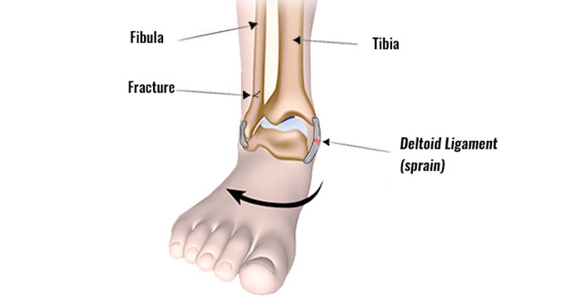 deltoid ligament ankle sprain