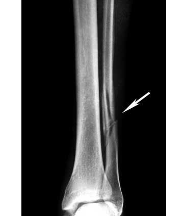 Fibula fracture X ray