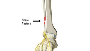 Fibula fracture