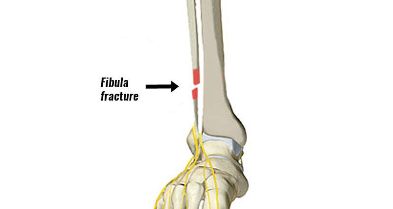 fibula fracture