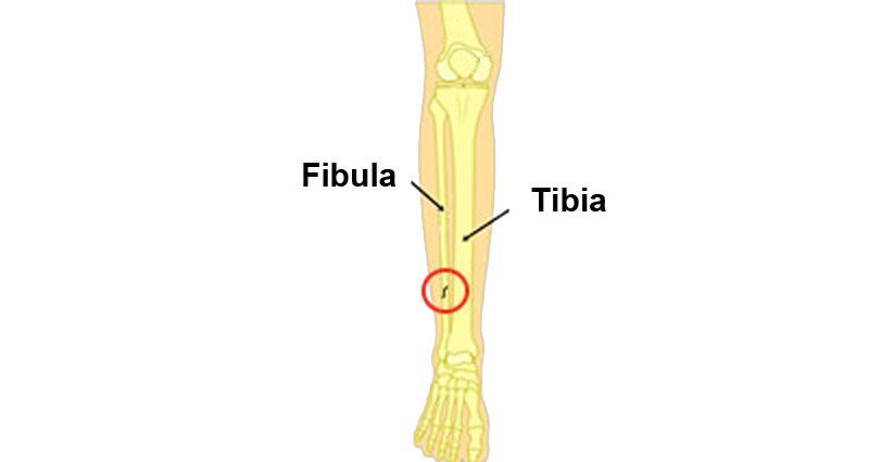 Fibula stress fracture