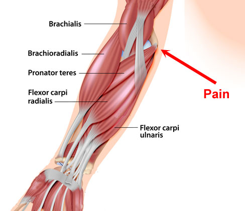 Golfer's Elbow - flexor muscles of the forearm