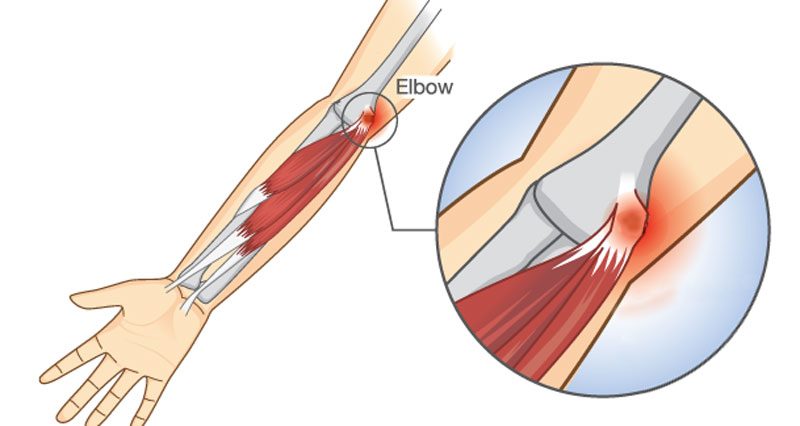 Golfer's elbow