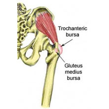 Hip Bursitis
