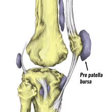 Housemaids Knee