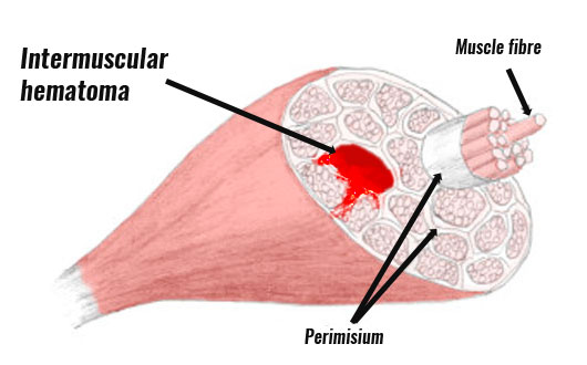 Intermuscular hematoma