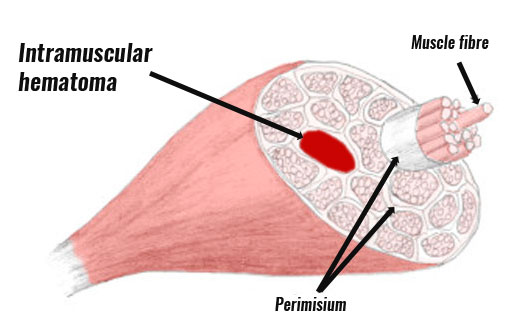 Intramuscular hematoma