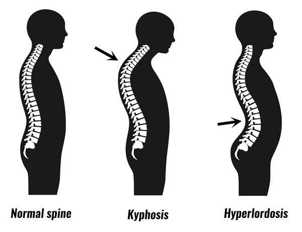 Kyphosis posture