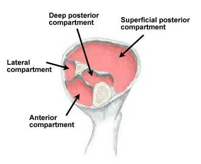 Compartments of the lower leg - posterior compartment syndrome
