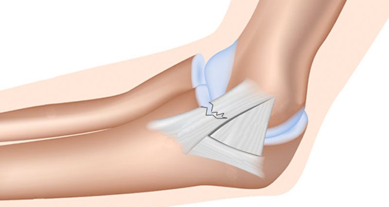 Medial elbow ligament sprain