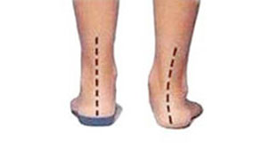 overpronation and supination of the foot