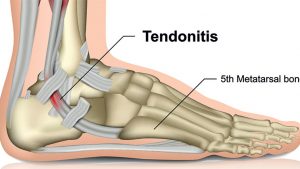 Peroneal tendonitis