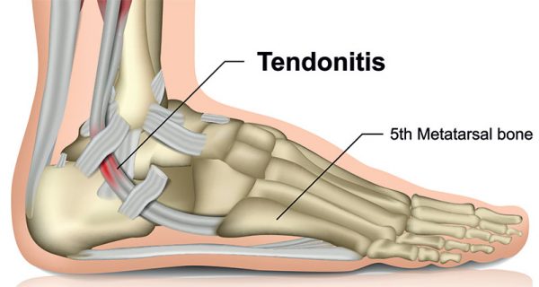 Peroneal tendonitis