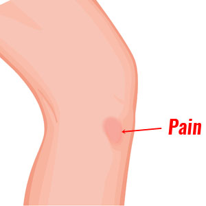 Pes anserine tendinopathy pain location