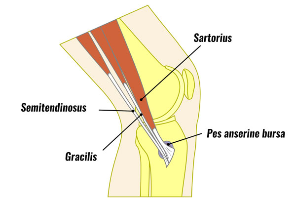 pes anserine tendinopathy and bursitis