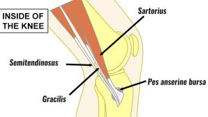 Pes anserine bursitis tendonitis