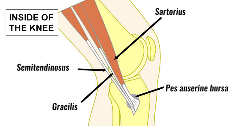 Pes anserine bursitis tendonitis